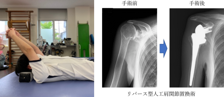 肩関節の術後の理学療法