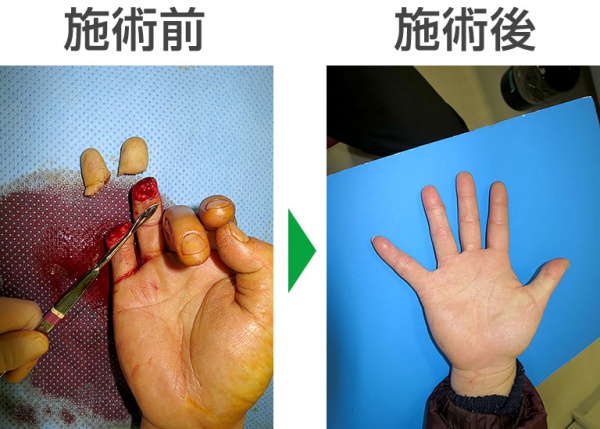 切断指の緊急対応 佐野記念病院 手の外科チーム